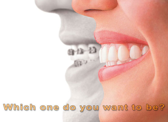 invisalign-03.jpg